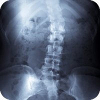 scoliosis chiropractic treatment spine sideways curve causes pain chiropractor help care shape