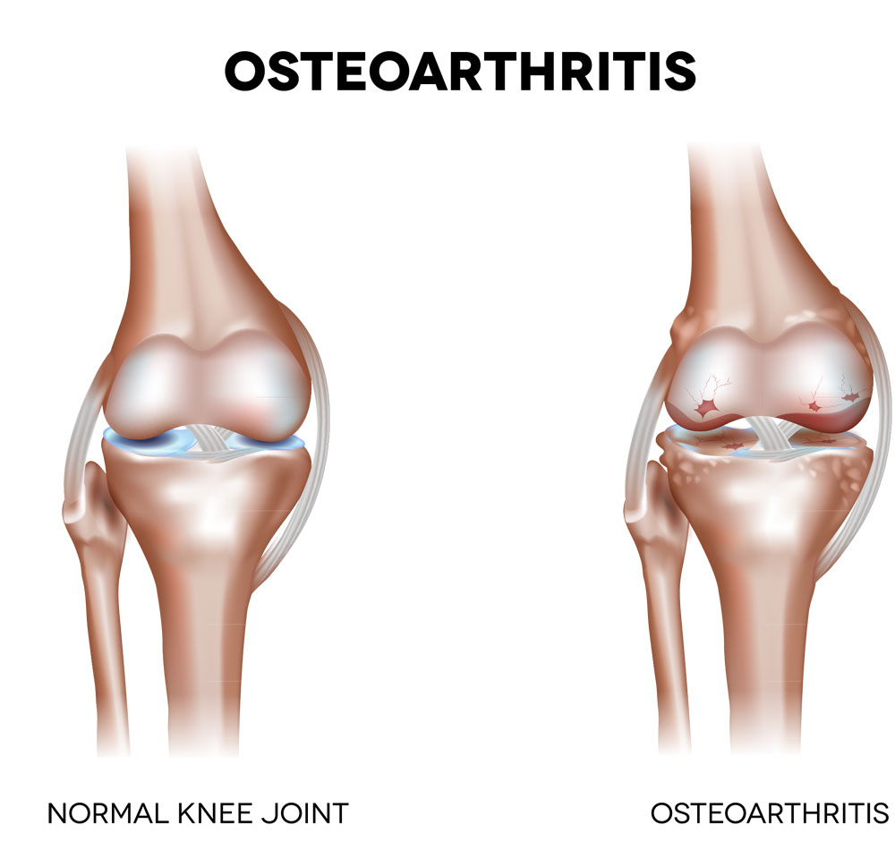 Osteoarthritis Treatment
