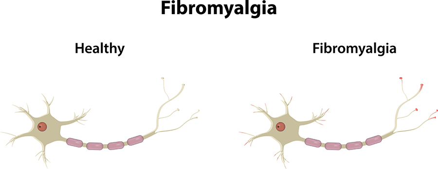 Treating Fibromyalgia With Chiropractic